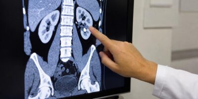 Los médicos explican las piedras en el riñón: cómo se detectan y cómo se evitan