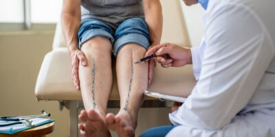Los médicos explican las varices en las piernas: por qué salen y qué las empeora