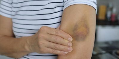 Por qué te salen moratones sin golpearte según los médicos