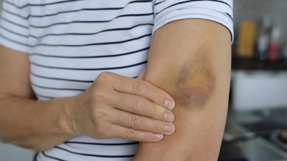 Por qué te salen moratones sin golpearte según los médicos
