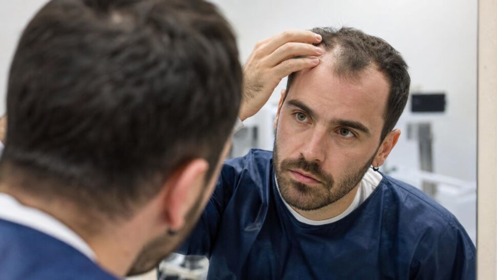 El avance contra la alopecia que ya se receta y del que casi nadie habla