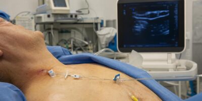 El avance contra la presión alta que no necesita pastillas y ya se aplica en hospitales