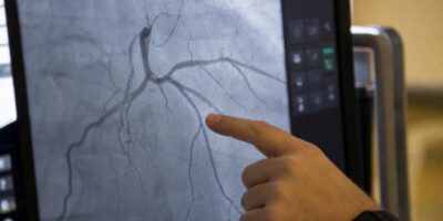 Los cardiólogos son categóricos con el aceite de oliva: esto es lo que hace en las arterias