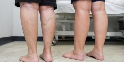 Por qué a unas personas les salen varices y a otras no