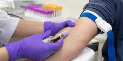 Qué significa de verdad tu nivel de ácido úrico en el análisis de sangre