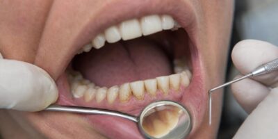 Soy dentista y esto es lo que veo en los dientes de quienes beben café con leche cada mañana
