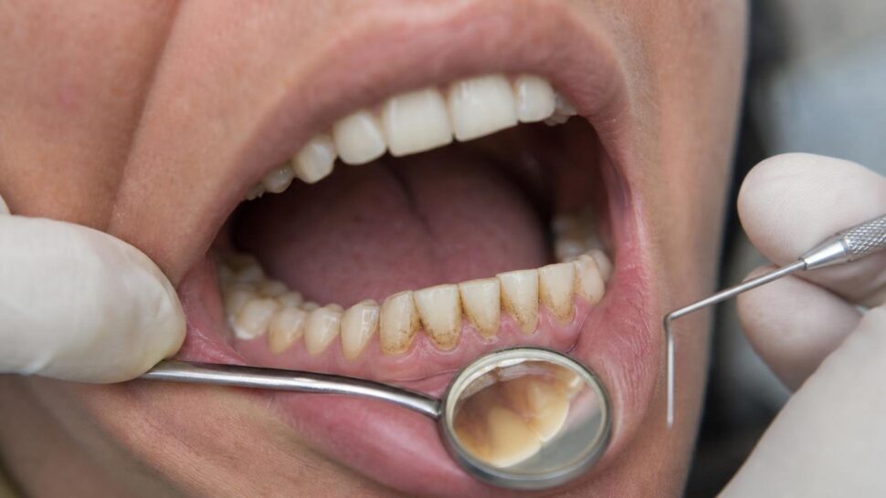 Soy dentista y esto es lo que veo en los dientes de quienes beben café con leche cada mañana