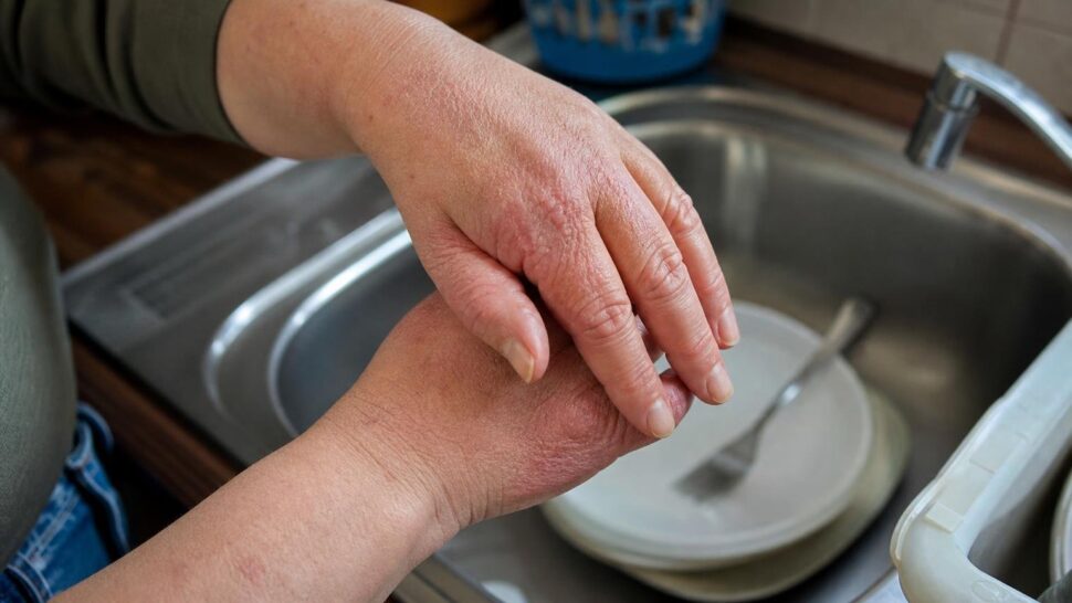 Soy dermatóloga y esto es lo que veo en las manos de quienes lavan los platos sin guantes