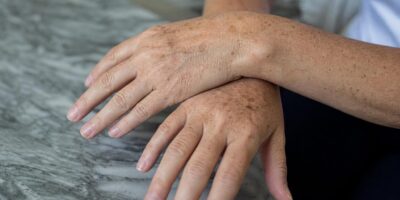 Un dermatólogo avisa: cada vez ve más manchas en las manos en personas de 40 años