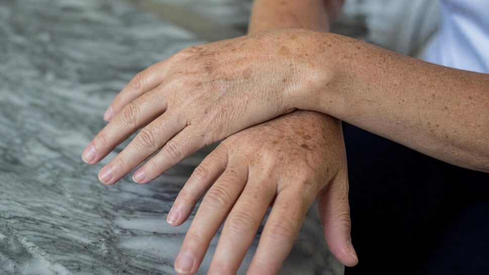 Un dermatólogo avisa: cada vez ve más manchas en las manos en personas de 40 años