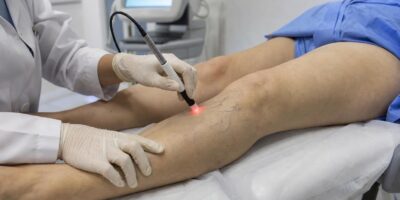 El avance contra las varices que no necesita cirugía y ya se hace en consulta