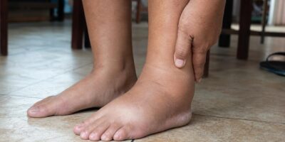 Si se te hinchan los tobillos al final del día mira lo que cenas: el alimento número 1 que señalan los médicos
