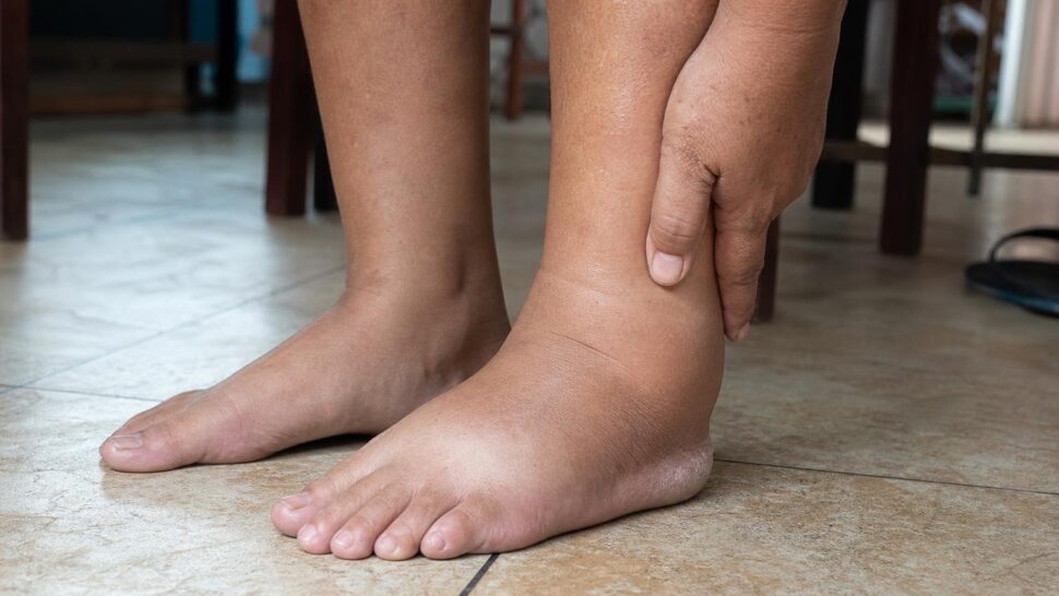 Si se te hinchan los tobillos al final del día mira lo que cenas: el alimento número 1 que señalan los médicos
