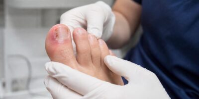 Un podólogo avisa: cada vez ve más uñas encarnadas en personas que se cortan las uñas redondeadas