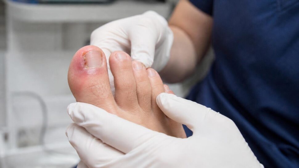 Un podólogo avisa: cada vez ve más uñas encarnadas en personas que se cortan las uñas redondeadas